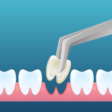 Tooth extraction concept in cartoon style. Teeth removal. Vector design