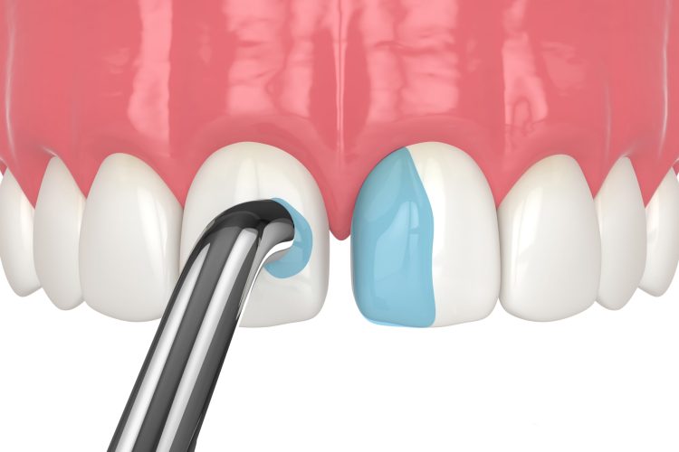 Dental Bonding 1